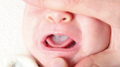 Bebeklerde Pamukçuk (Ağız Yaraları) Sebepleri ve Tedavisi