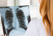 Akciğer Sönmesi Belirtileri Nelerdir, Nasıl Tedavi Edilir1