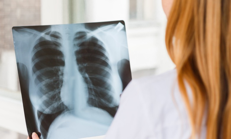 Akciğer Sönmesi Belirtileri Nelerdir, Nasıl Tedavi Edilir1