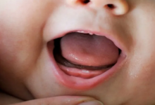 Bebeklerde Diş Eti İltihabının Önlenmesi ve Tedavi Süreci1