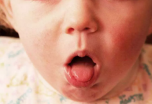 Bebeklerde Krup Hastalığı Belirtileri ve Tedavi Yöntemleri1