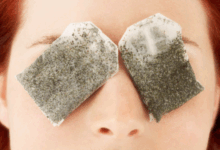 Göz Altı Morluklarına Doğal Çözümlerle Etkili Yöntemler